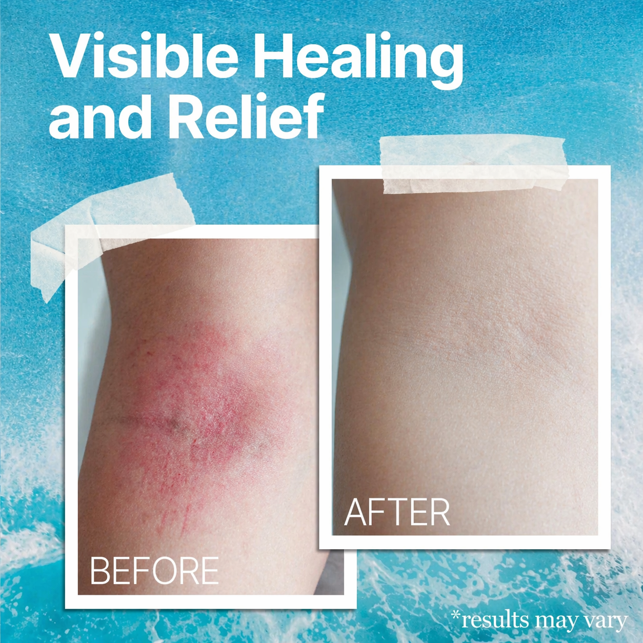 The Ocean Healed My Eczema™ Natural Soothing Cream – Anti-Itch Relief